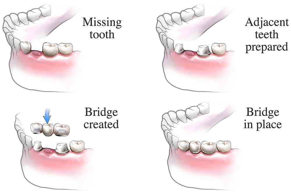 Dental Bridge Procedure - used by Alrewas Dental Practice - your local dentists in Burton on Trent, Fradley, Alrewas & Barton under Needwood