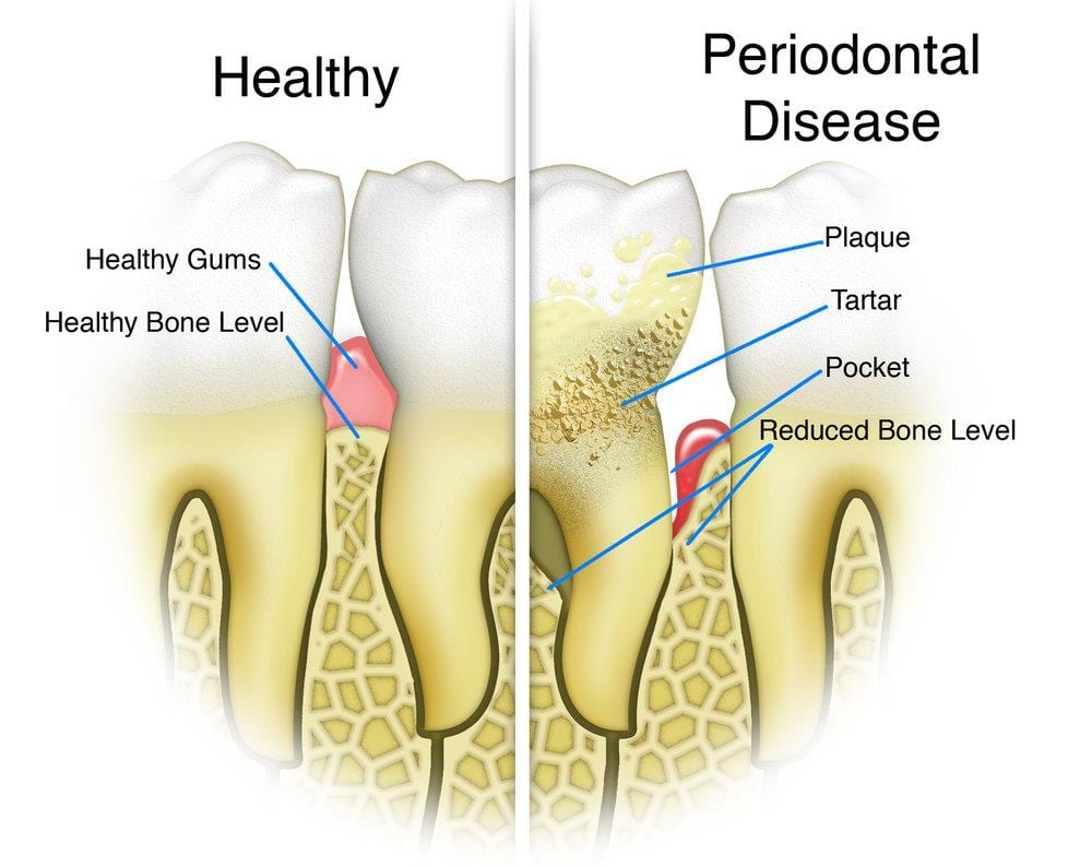 Periodontal Gum Disease Treatment Infographic Comparing healthy gums and teeth with gum disease. Shows reduced bone levels compared to healthy gums and build up of plaque and tartar together with receding gums. Alrewas Dental Practice near Burton on Trent and Barton under Needwood are dentists specialising in gum disease treatment