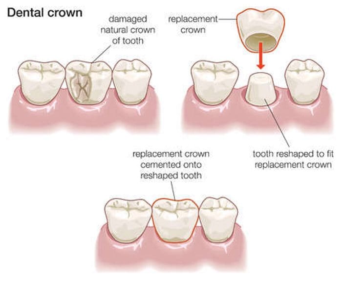 Procedure for Fitting Dental Crowns at our dentists in Burton on Trent