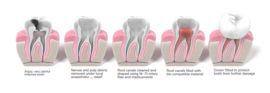 Root Canal Treatment Stages infographic (Stage 1 - Angry inflamed Tooth, Stage 2 - Nerves and pulp debris removed under local anaesthetic for relief, Stage 3 - Root canals cleaned and shaped, stage 4 - root canals filled with bio compatible material, stage 5 - crown fitted to protect the tooth from further damage) from Alrewas Dental Practice Near Burton on Trent