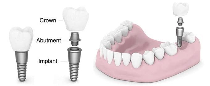 What is a Dental Implant - Infographic from ADP - Your Dentists in Burton on Trent