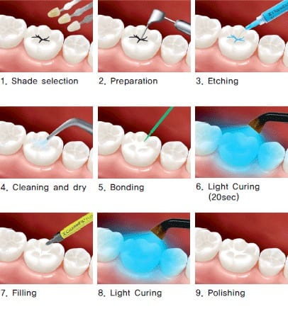 White fillings Process at Alrewas Dentists near Burton on Trent and Barton under needwood